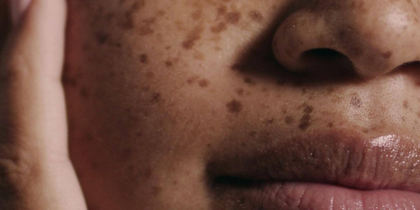 Dermatologists' Top Picks for Oily Skin Care