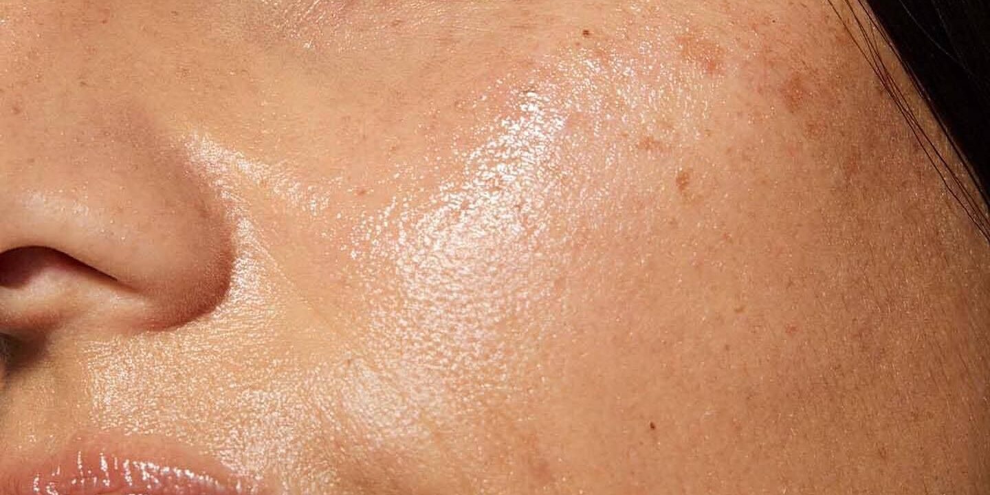This traditional Chinese medicine trick clears up acne breakouts quickly.